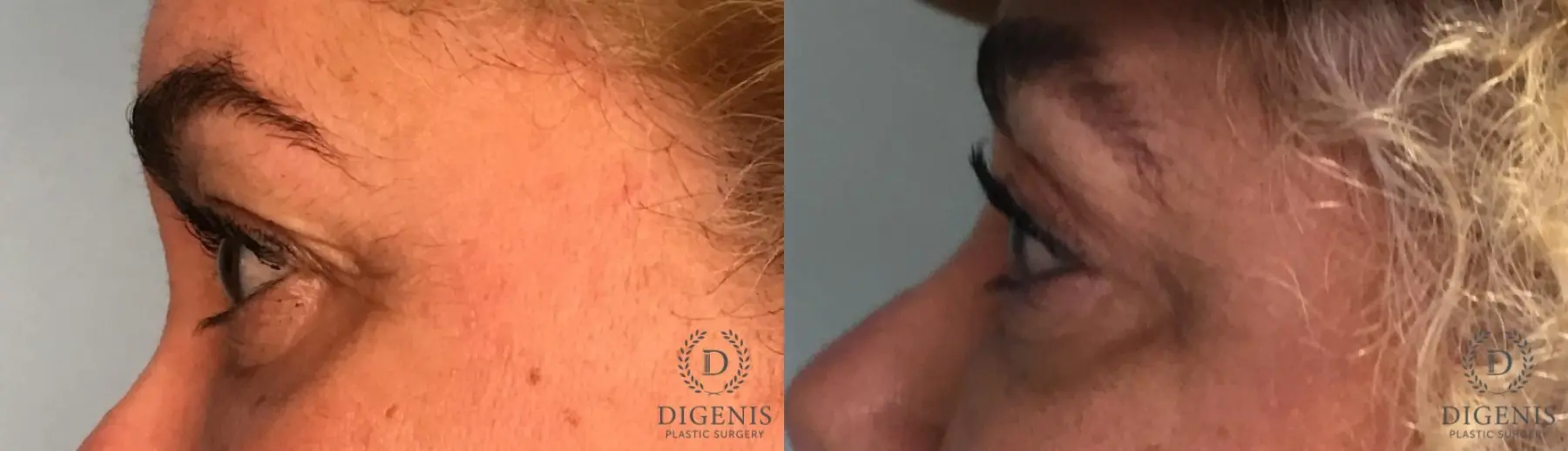Eyelid Surgery: Patient 13 - Before and After 3