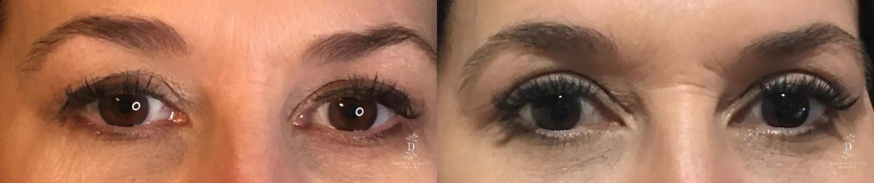 Eyelid Surgery: Patient 30 - Before and After 1