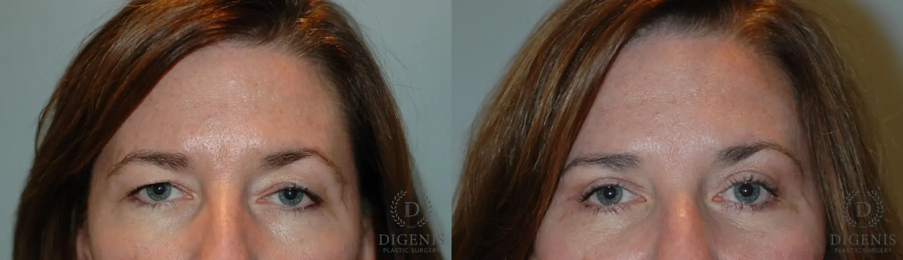 Eyelid Surgery: Patient 3 - Before and After 1