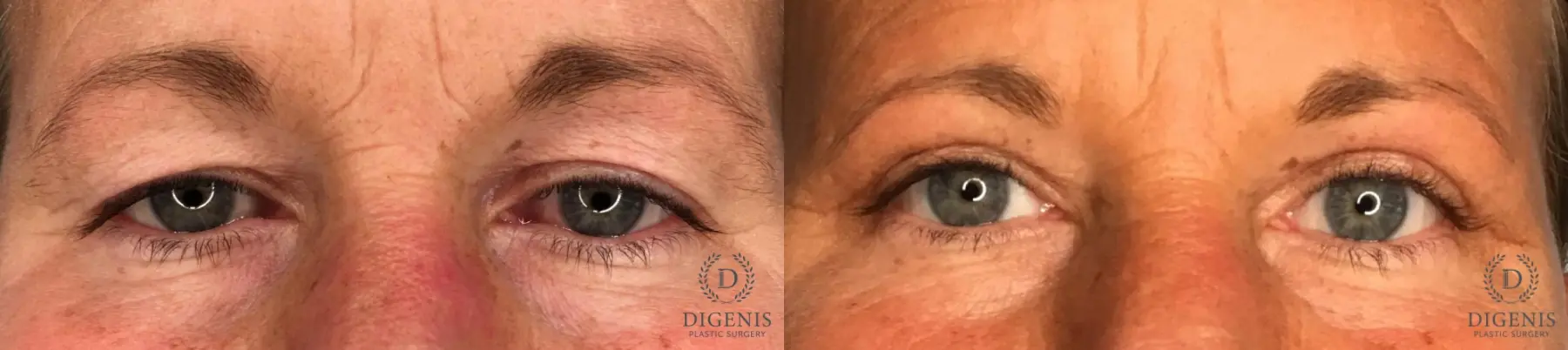Eyelid Surgery: Patient 69 - Before and After 1