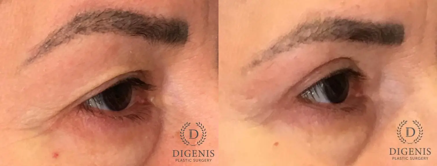 Eyelid Surgery: Patient 67 - Before and After 4