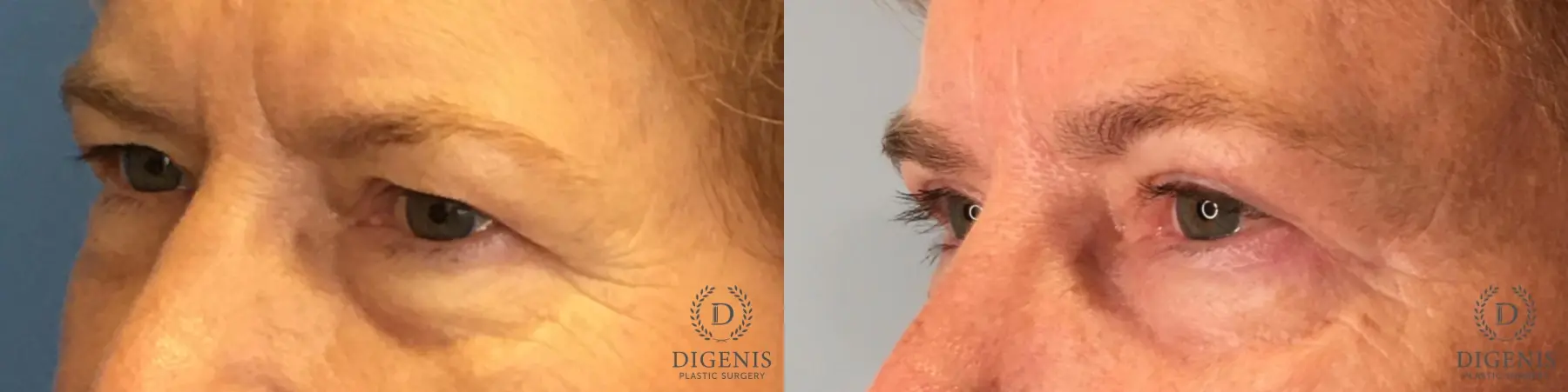 Eyelid Surgery: Patient 58 - Before and After 4