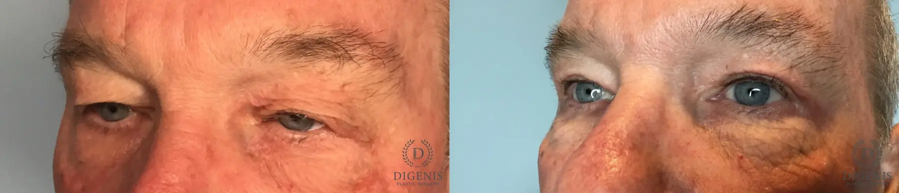 Eyelid Surgery: Patient 14 - Before and After 2