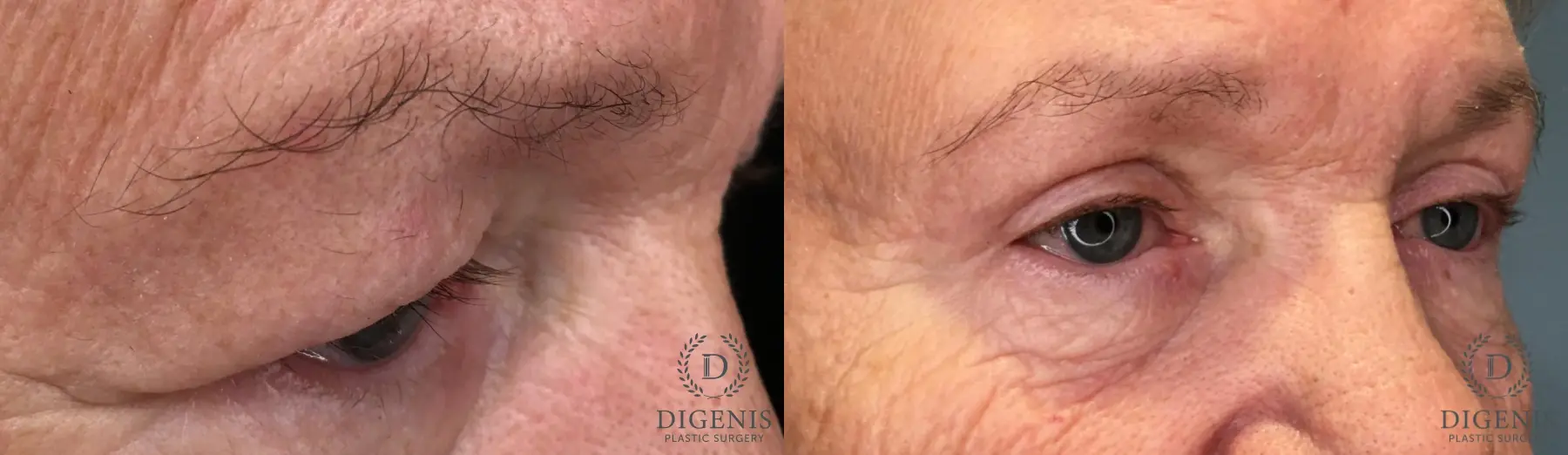 Eyelid Surgery: Patient 61 - Before and After 5