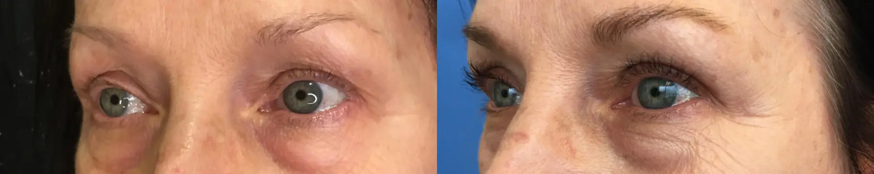 Eyelid Surgery: Patient 24 - Before and After 4
