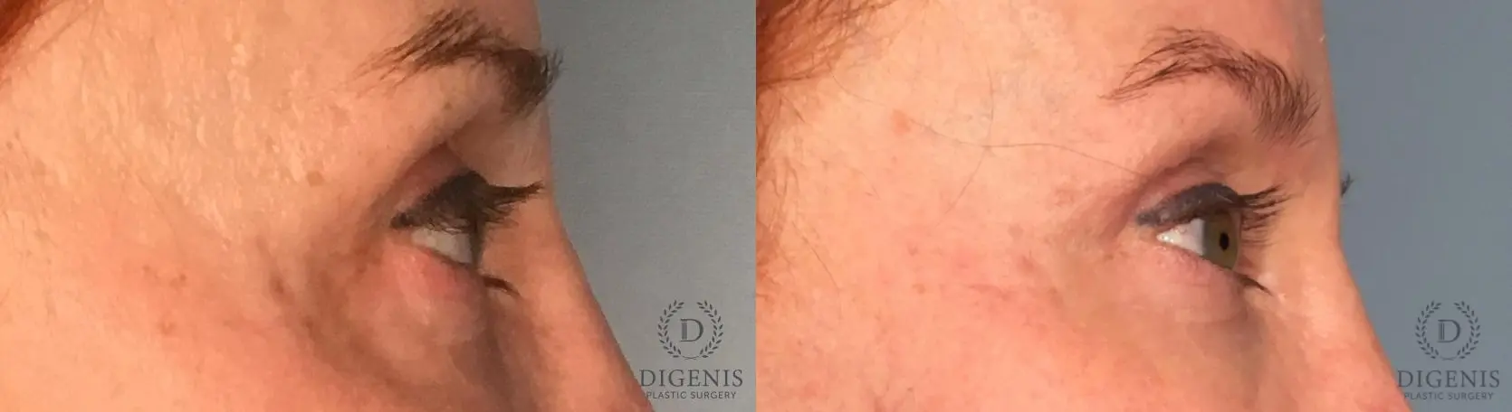 Eyelid Surgery: Patient 7 - Before and After 5