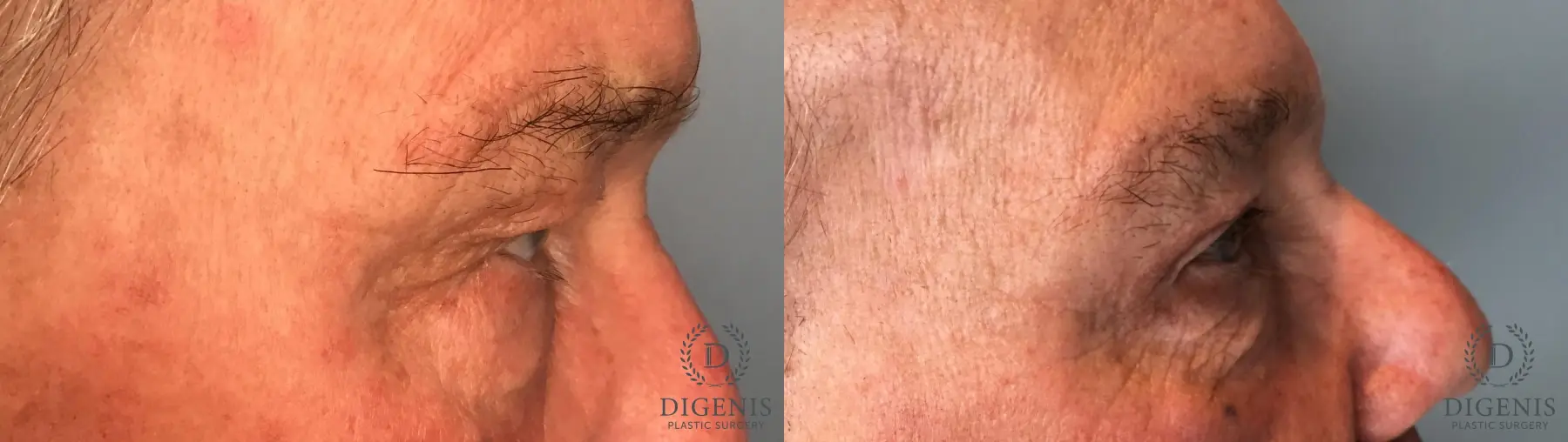 Eyelid Surgery: Patient 14 - Before and After 5