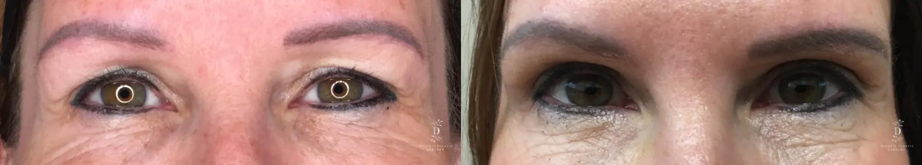 Eyelid Surgery: Patient 28 - Before and After 1