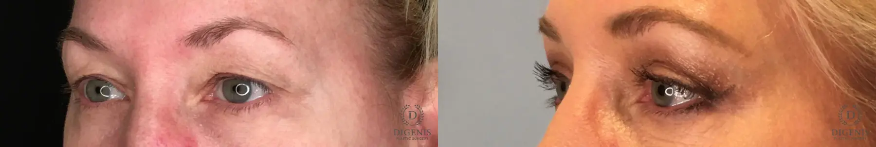 Eyelid Surgery: Patient 51 - Before and After 2