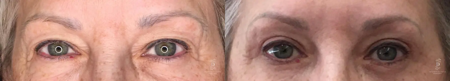 Eyelid Surgery: Patient 29 - Before and After 1