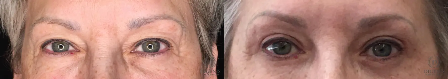 Eyelid Surgery: Patient 29 - Before and After  