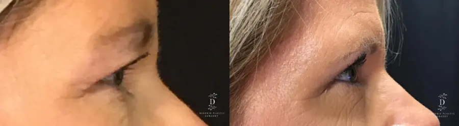 Eyelid Surgery: Patient 14 - Before and After 3