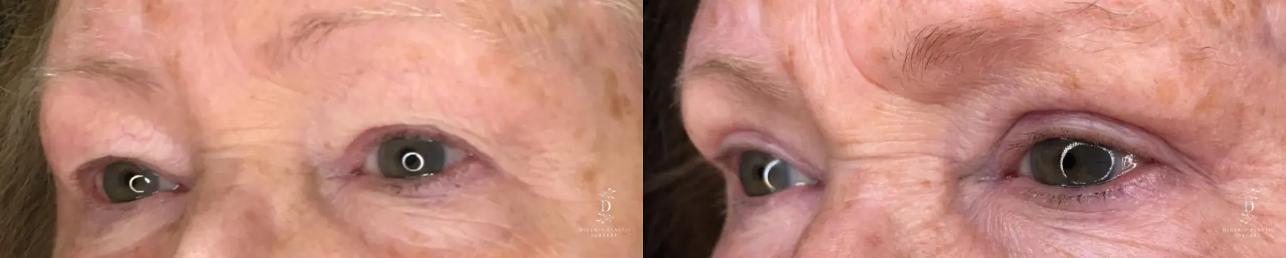 Eyelid Surgery: Patient 25 - Before and After 4