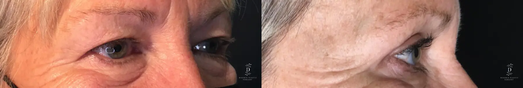 Eyelid Surgery: Patient 33 - Before and After 2