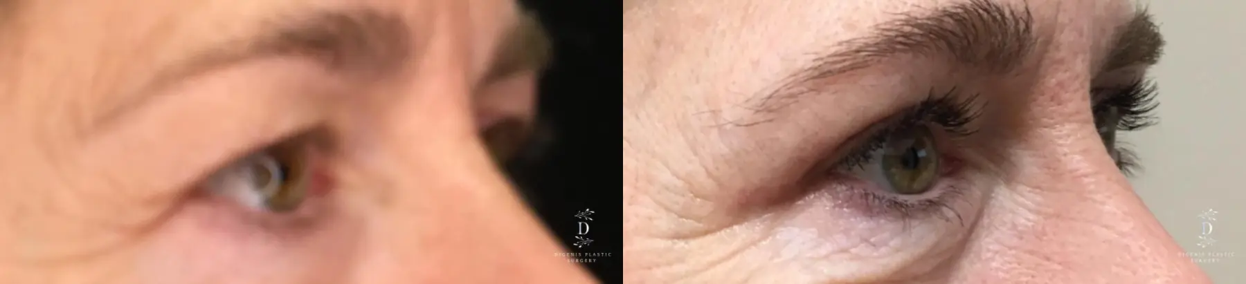 Eyelid Surgery: Patient 32 - Before and After 2