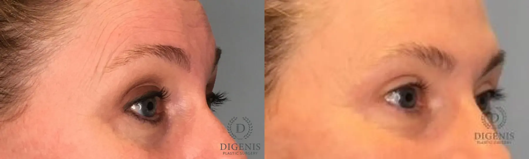 Eyelid Surgery: Patient 12 - Before and After 2