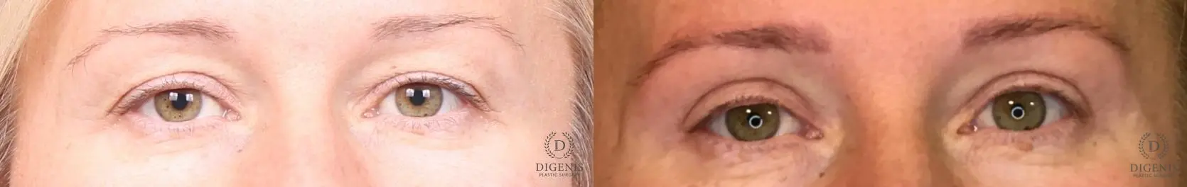 Eyelid Surgery: Patient 10 - Before and After  