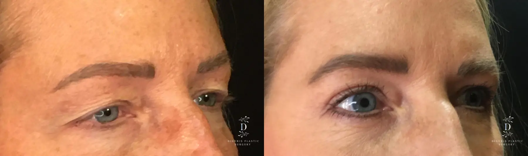 Eyelid Surgery: Patient 13 - Before and After 2