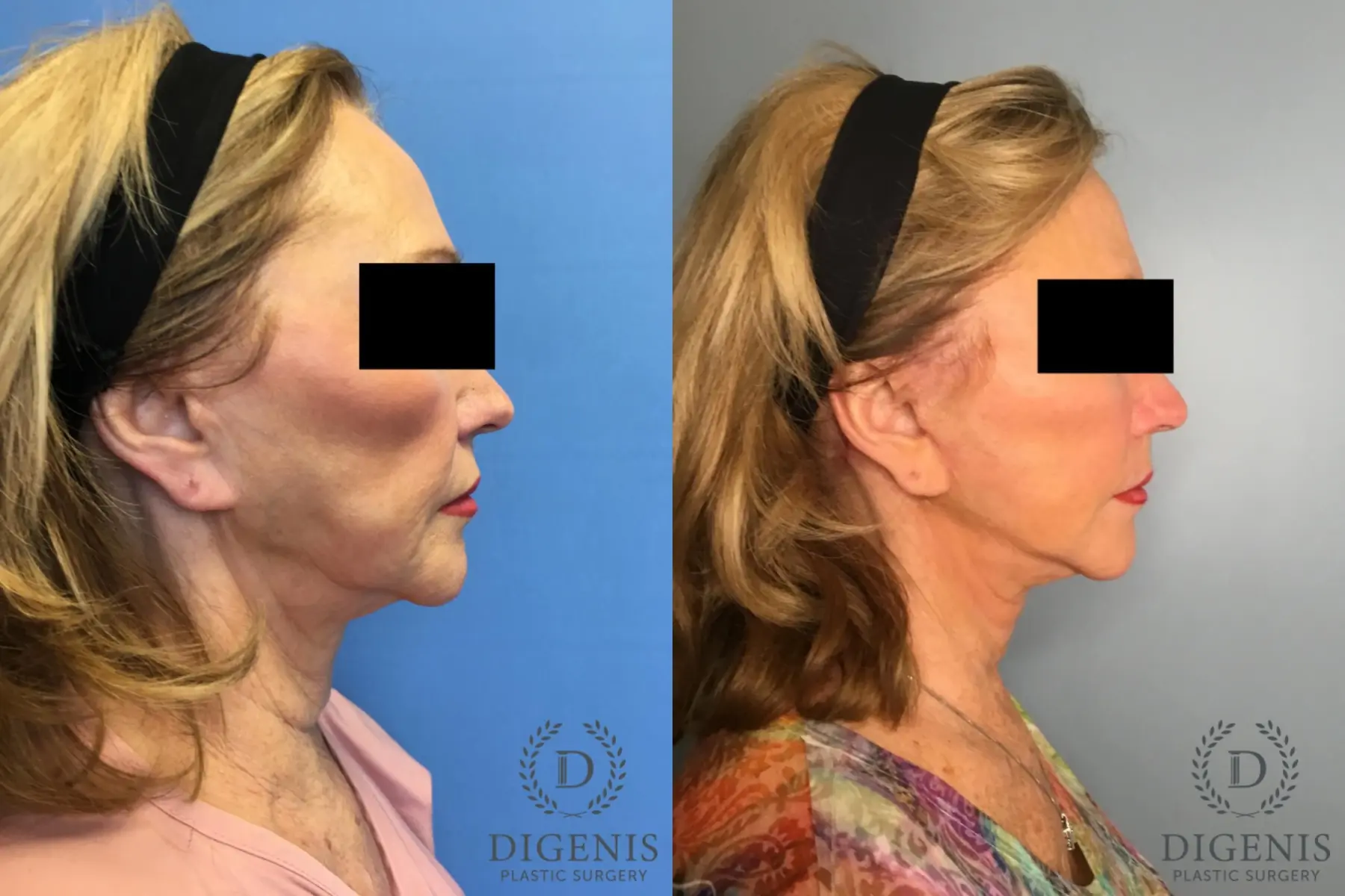 Facelift: Patient 25 - Before and After 3