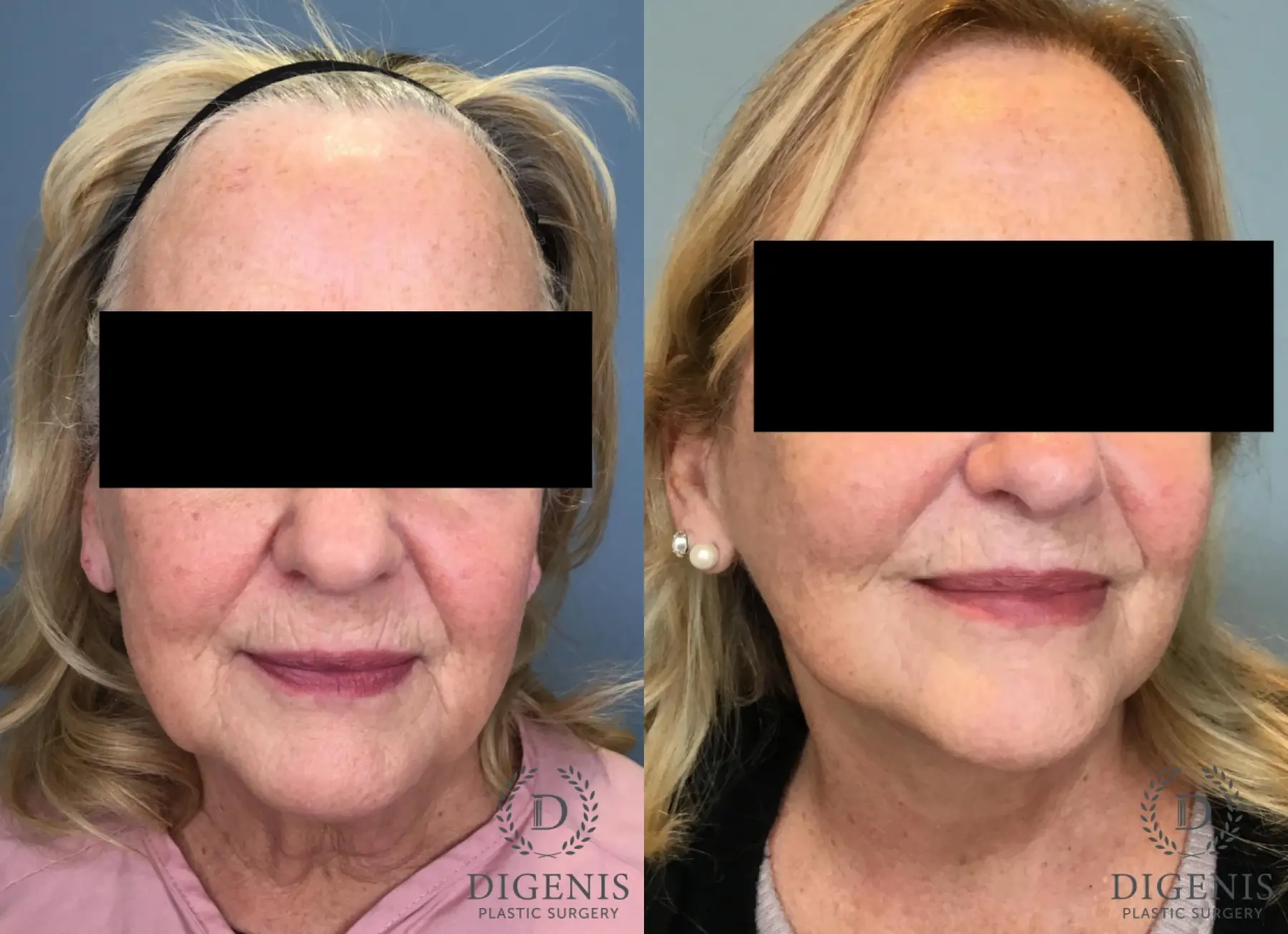 Facelift: Patient 73 - Before and After  