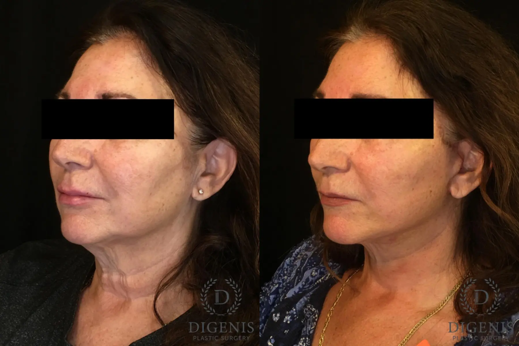 Facelift: Patient 5 - Before and After 3