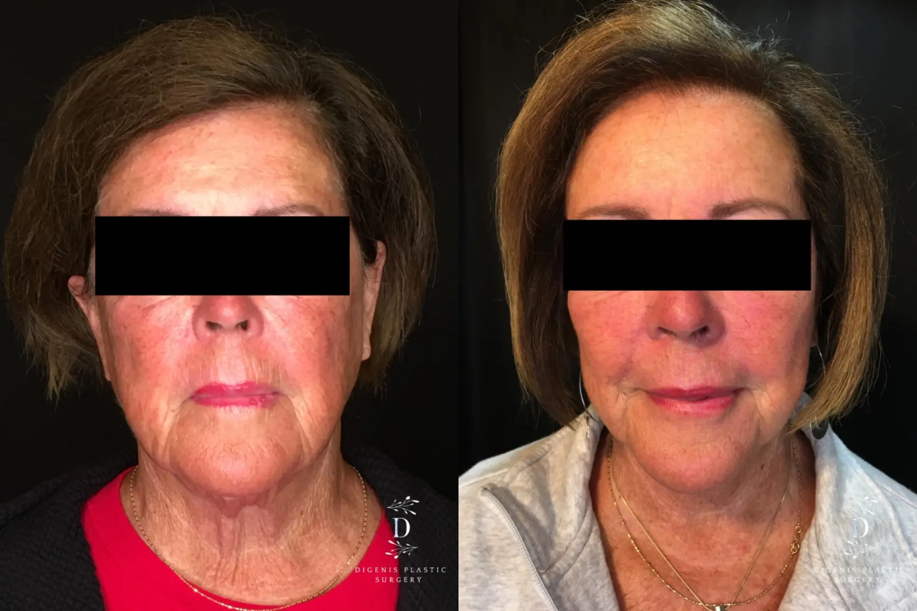 Facelift: Patient 17 - Before and After  