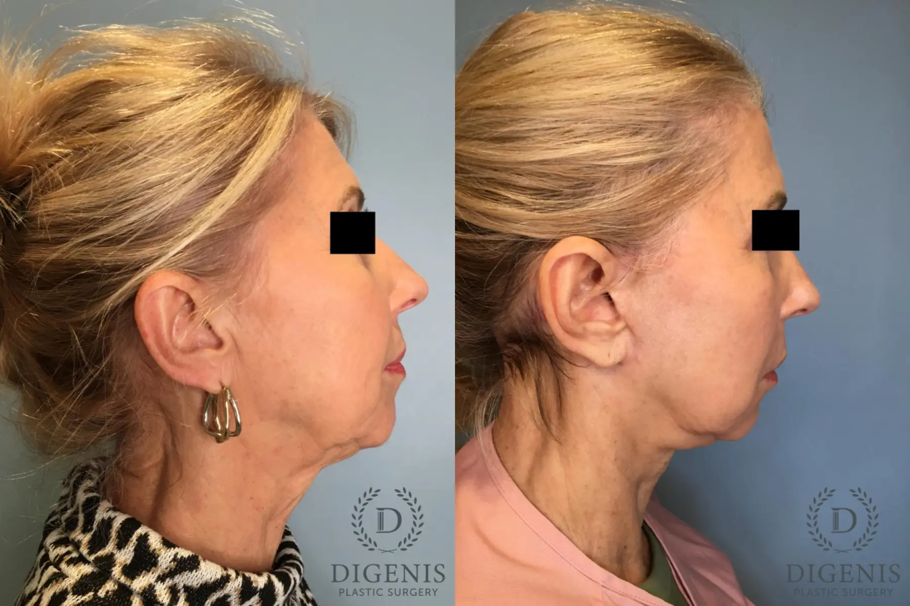 Facelift: Patient 15 - Before and After 3