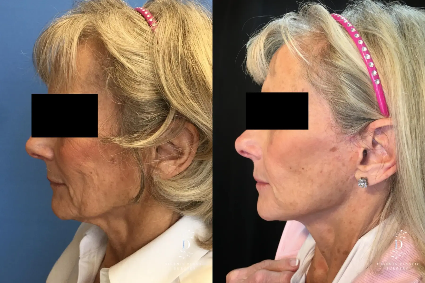 Facelift: Patient 19 - Before and After 4