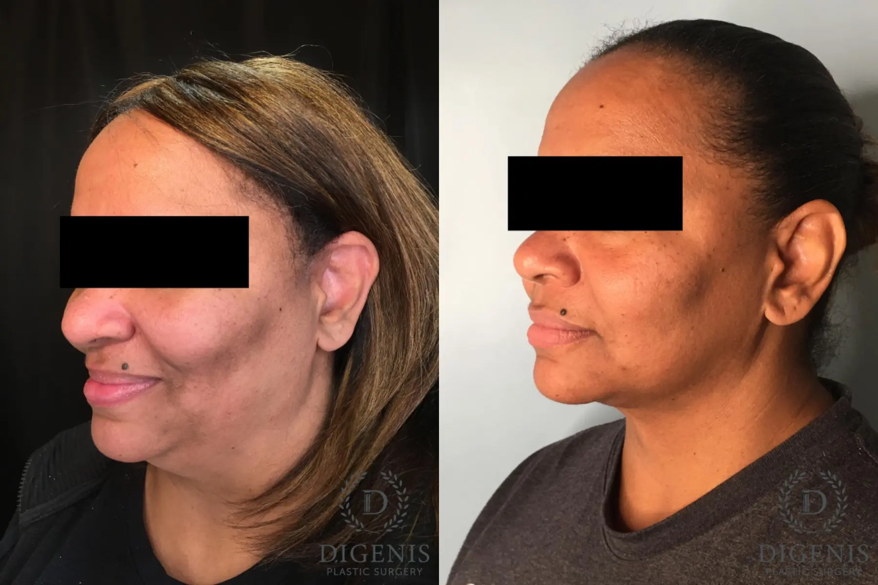 Facelift: Patient 63 - Before and After 4