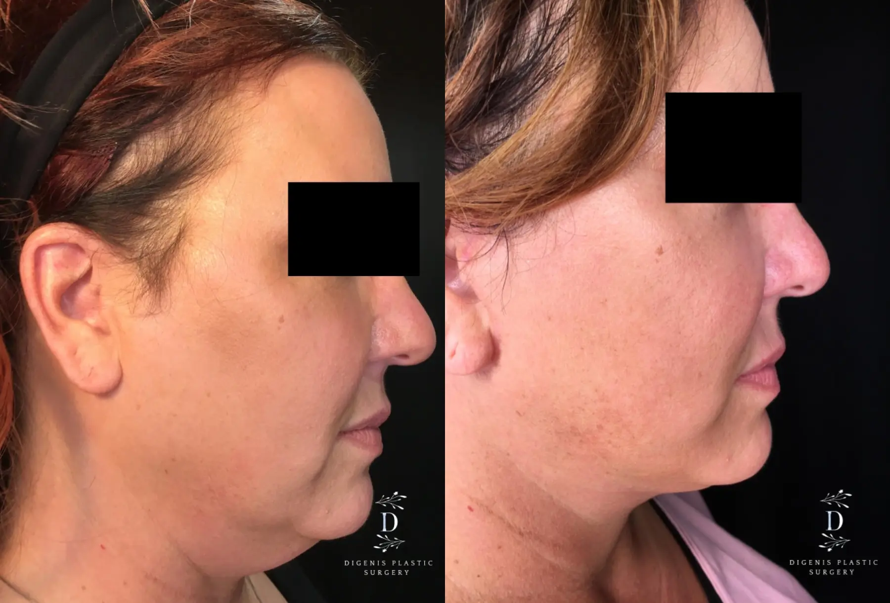 Facelift: Patient 22 - Before and After 3