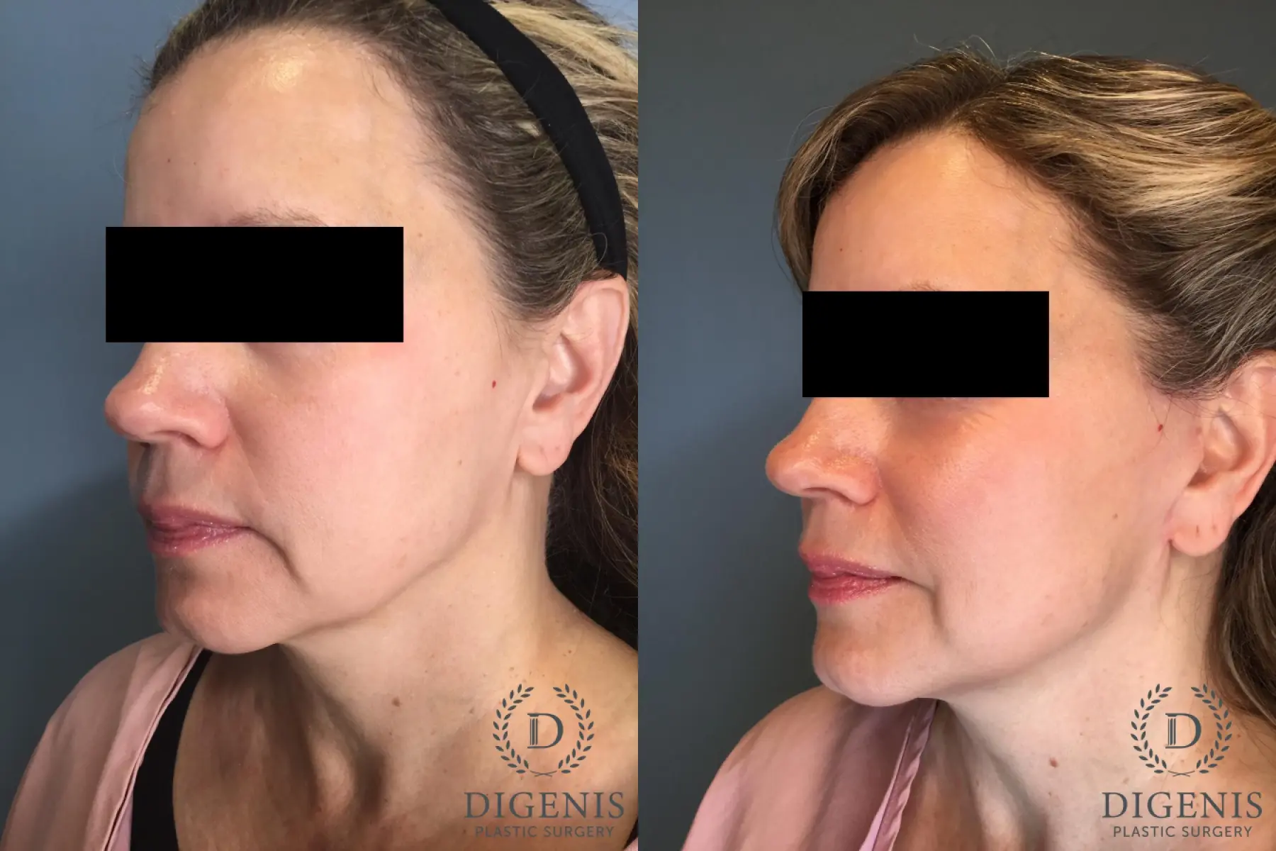 Facelift: Patient 60 - Before and After 2