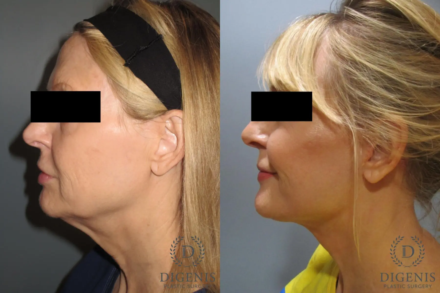 Facelift: Patient 6 - Before and After 5