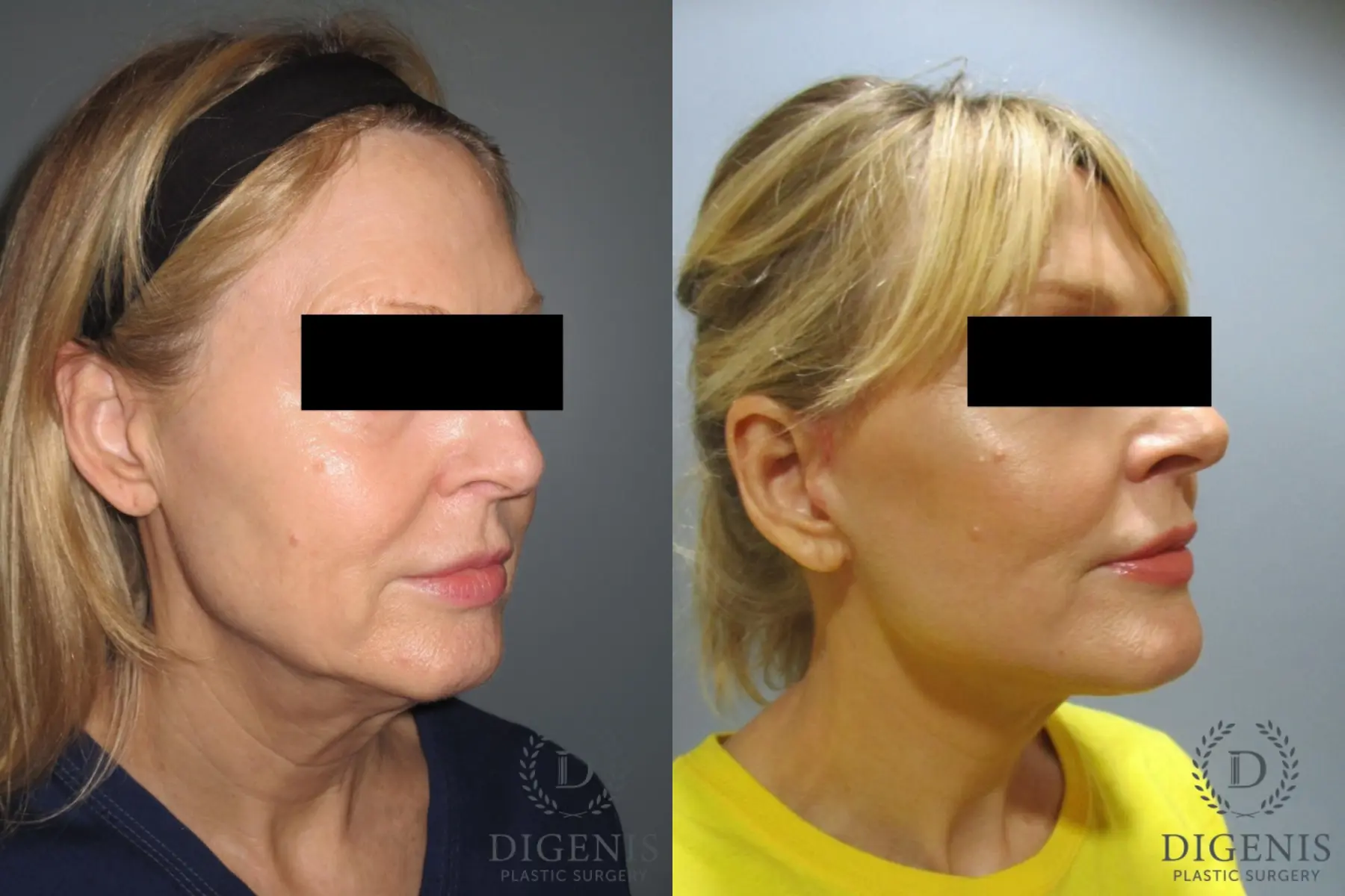 Facelift: Patient 6 - Before and After 2