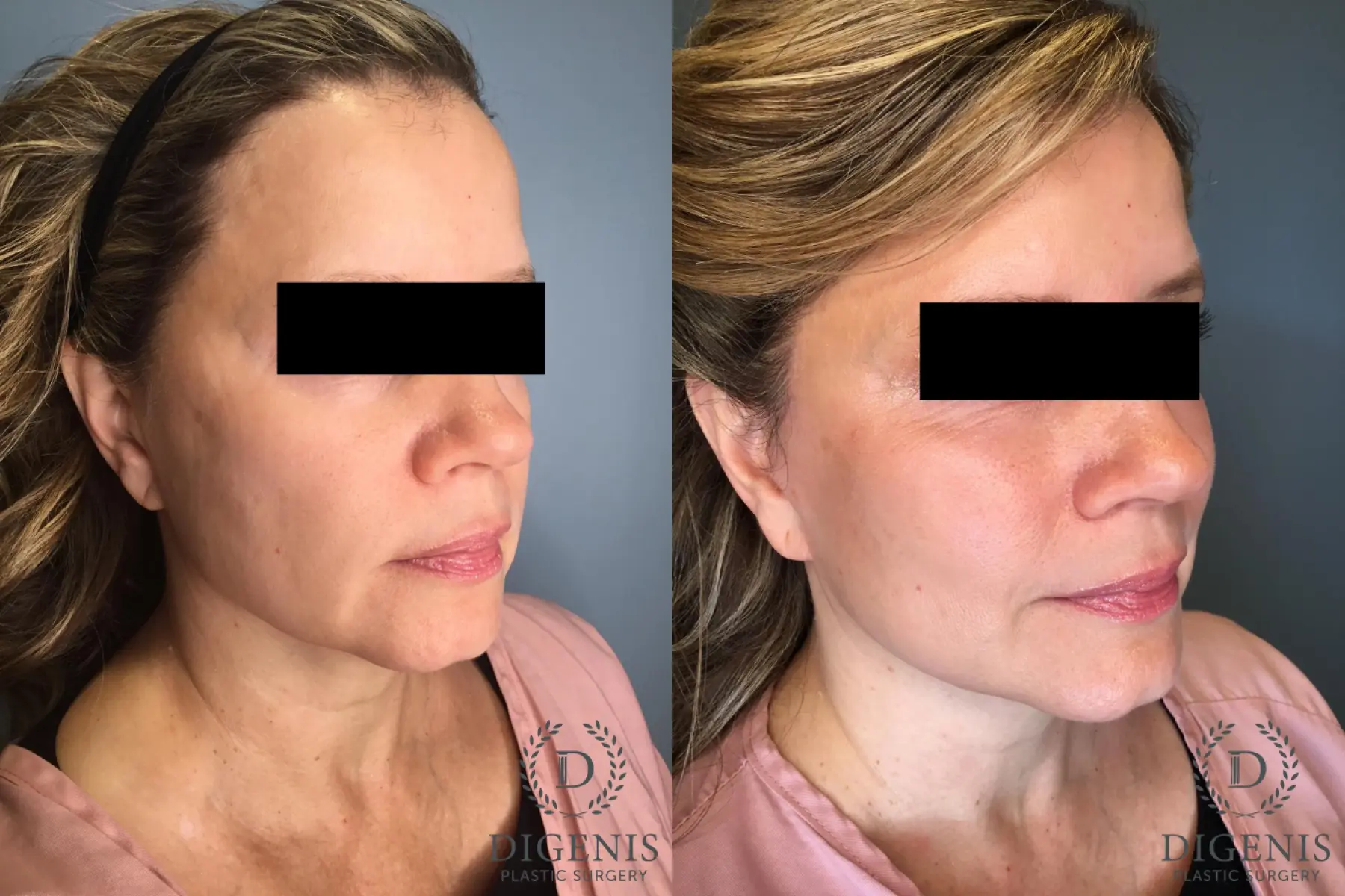 Facelift: Patient 60 - Before and After 4