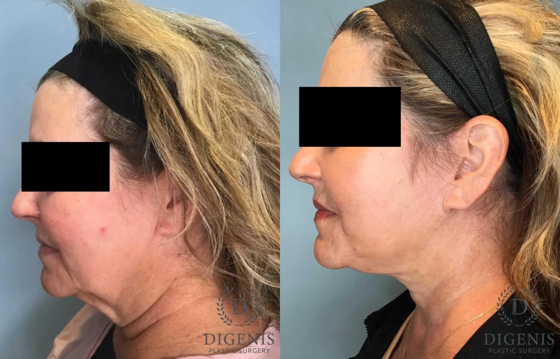 Facelift: Patient 61 - Before and After 3