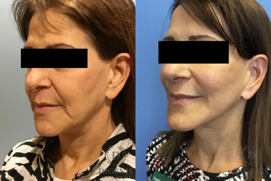 Facelift: Patient 6 - Before and After 4