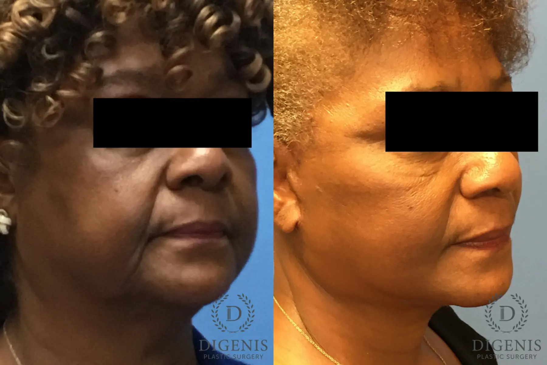 Facelift: Patient 8 - Before and After 2