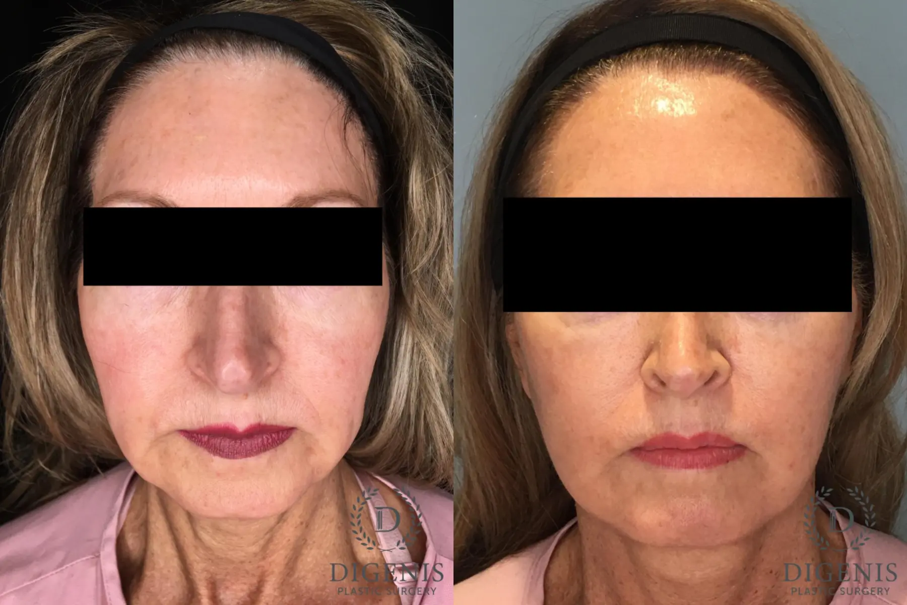 Facelift: Patient 32 - Before and After  