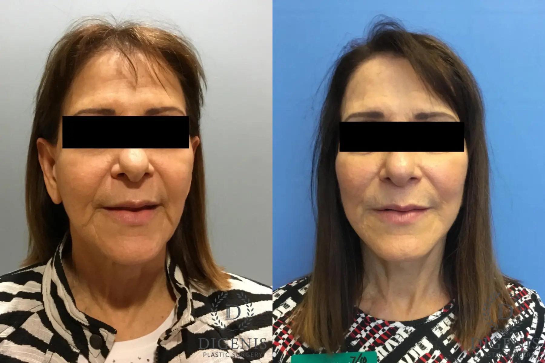 Facelift: Patient 7 - Before and After  