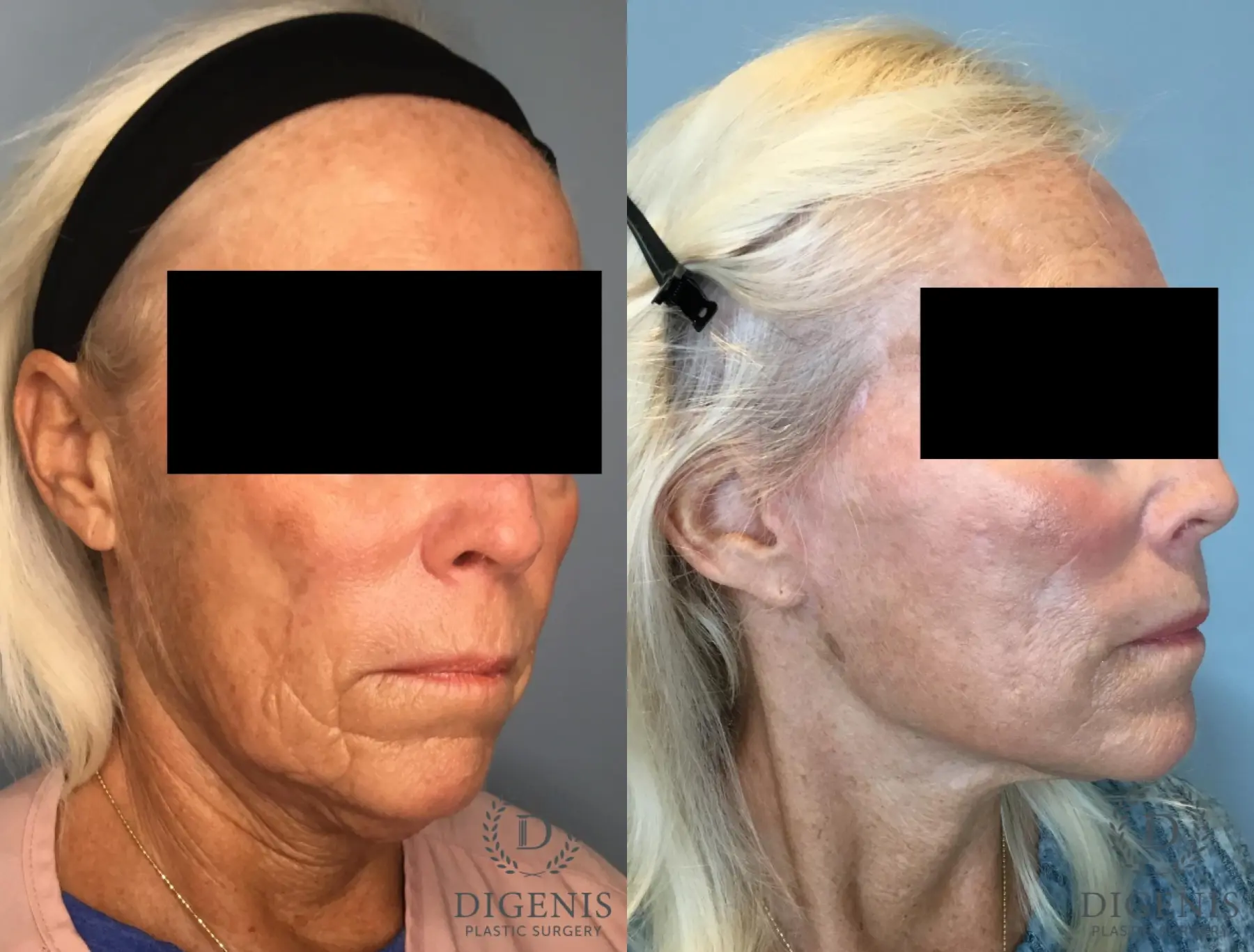 Facelift: Patient 63 - Before and After 4
