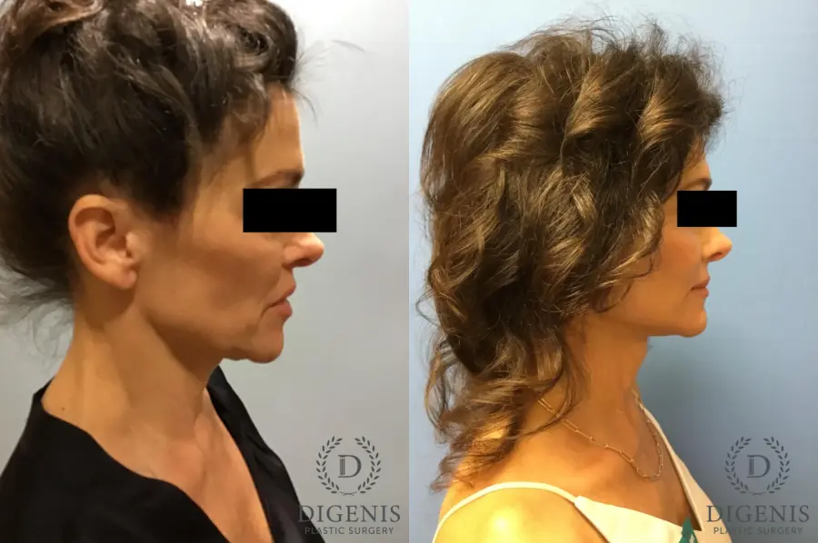 Facelift: Patient 9 - Before and After 5