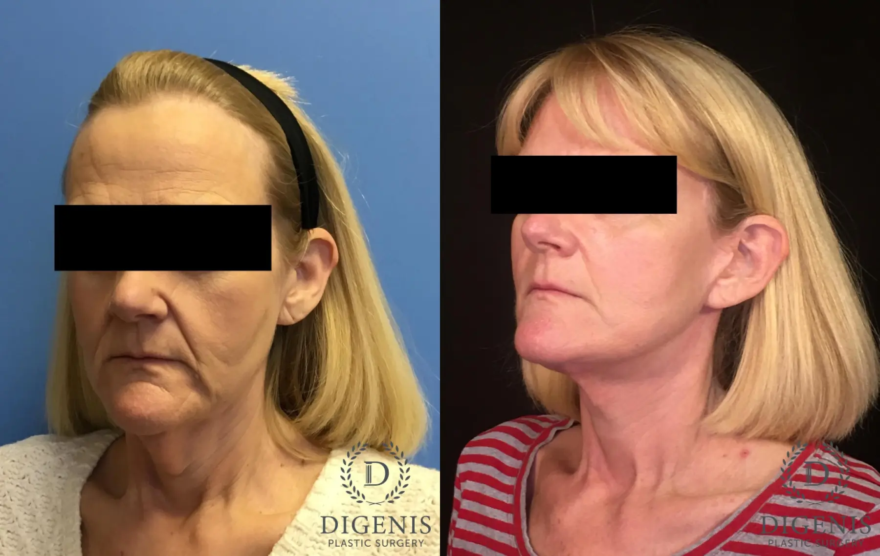 Facelift: Patient 4 - Before and After 4
