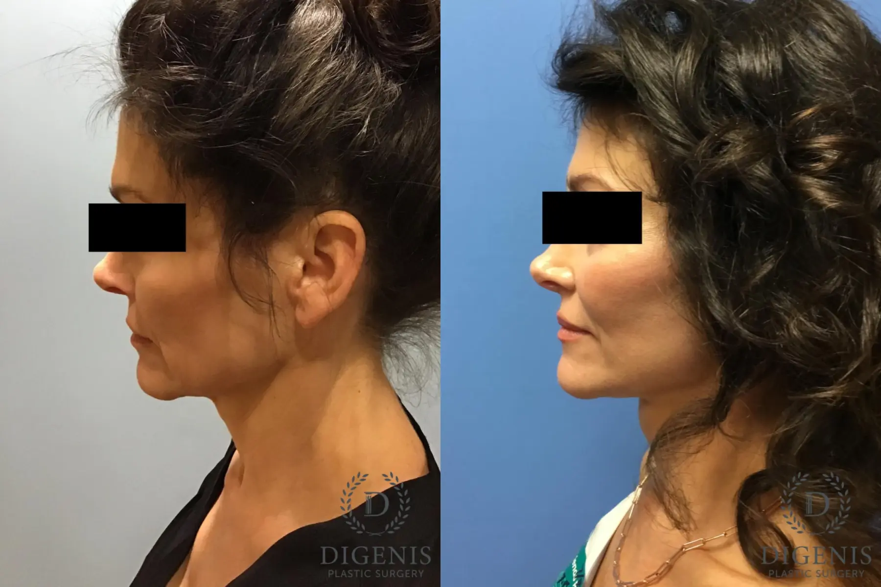 Facelift: Patient 9 - Before and After 3