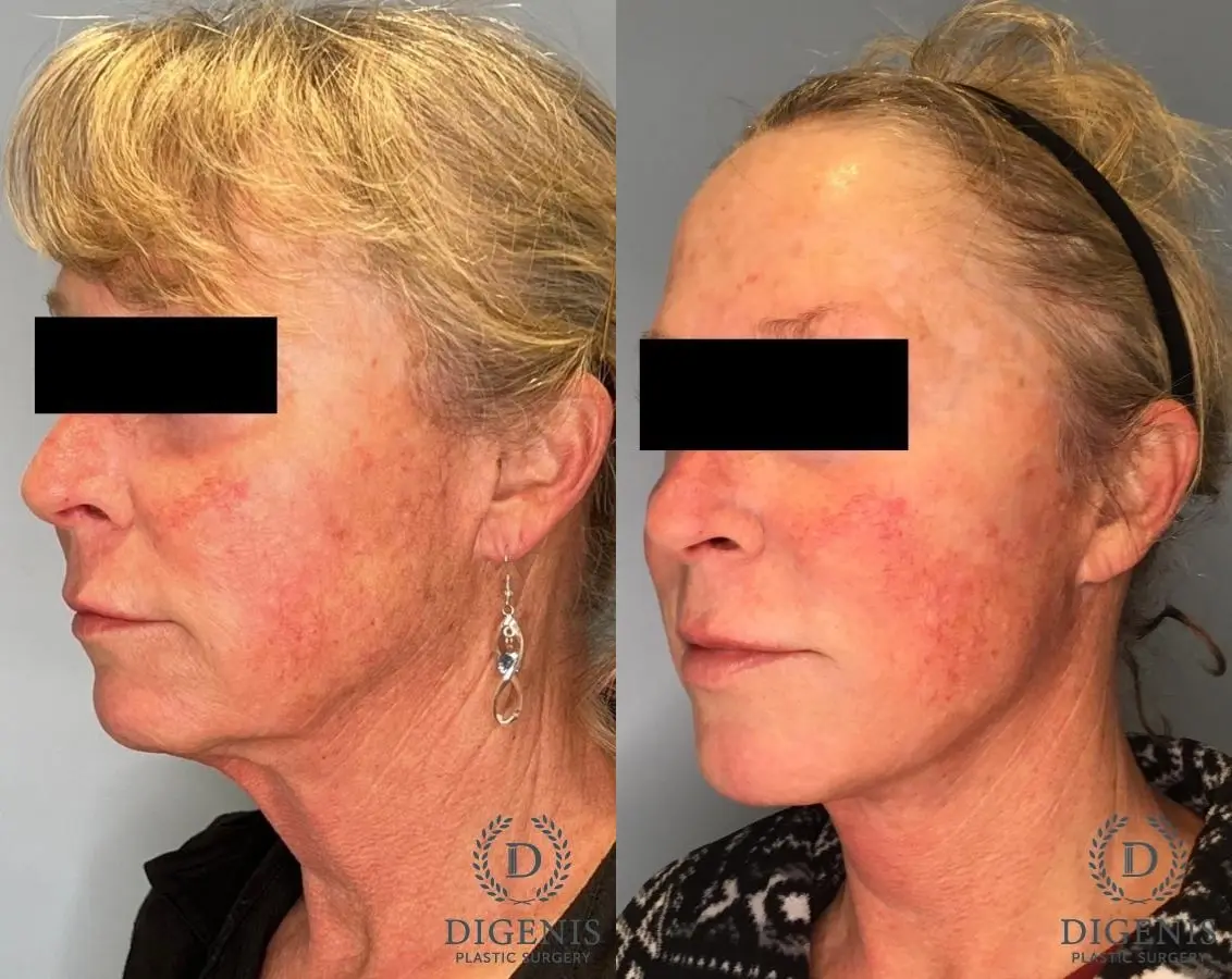 Facelift: Patient 17 - Before and After 3