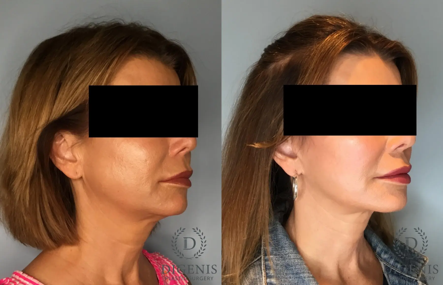 Facelift: Patient 72 - Before and After 2