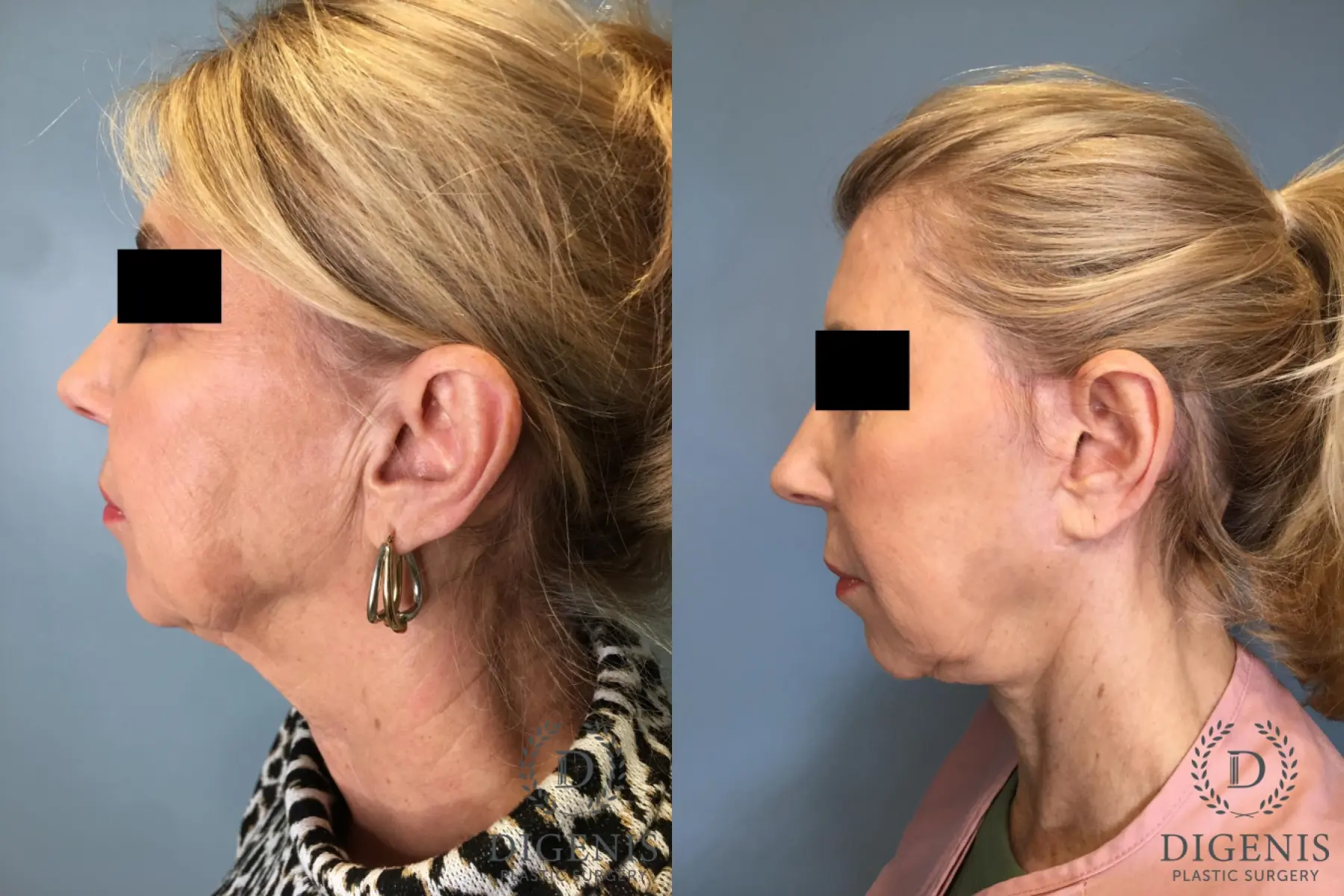 Facelift: Patient 15 - Before and After 5