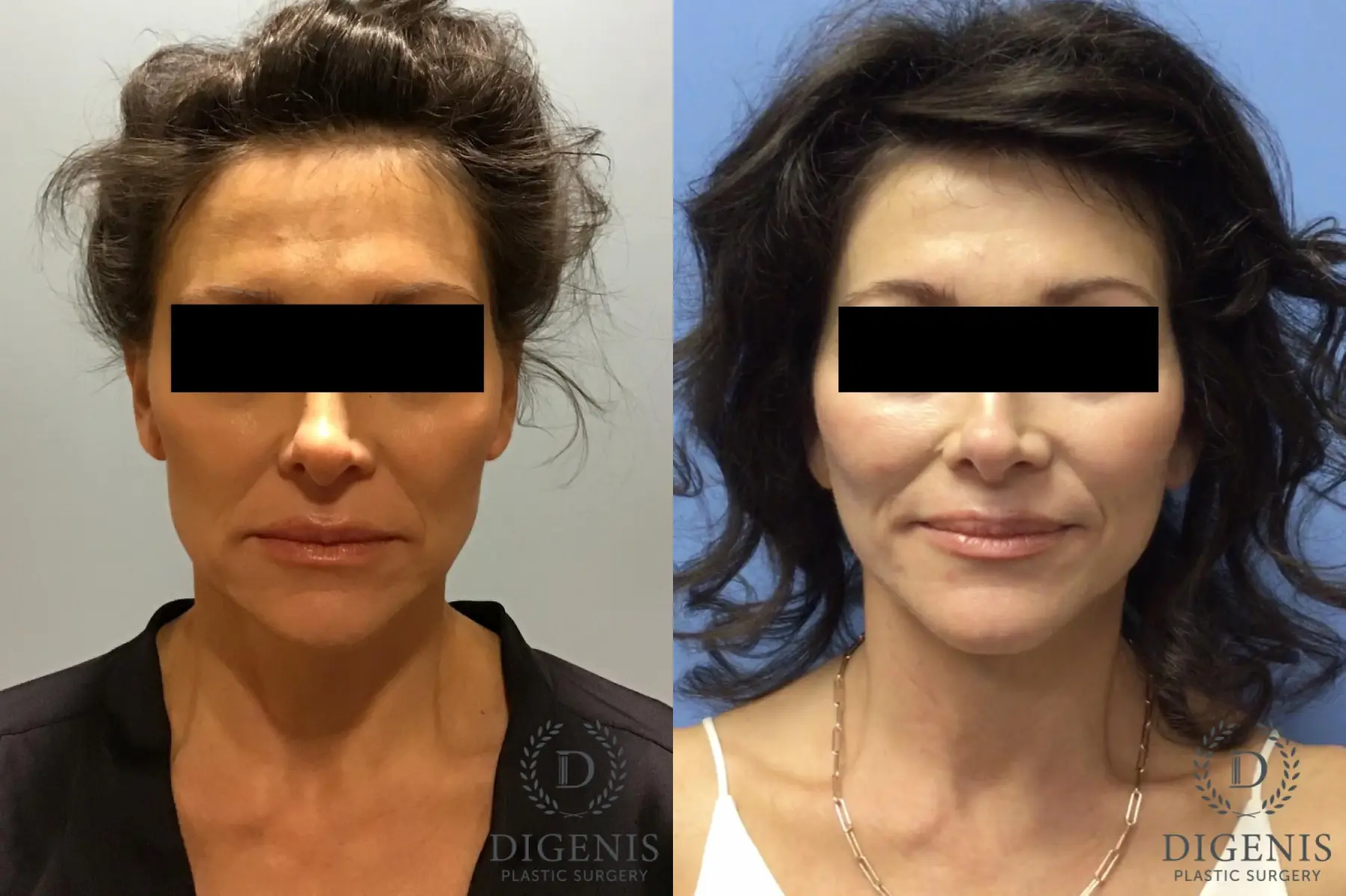 Facelift: Patient 10 - Before and After 1