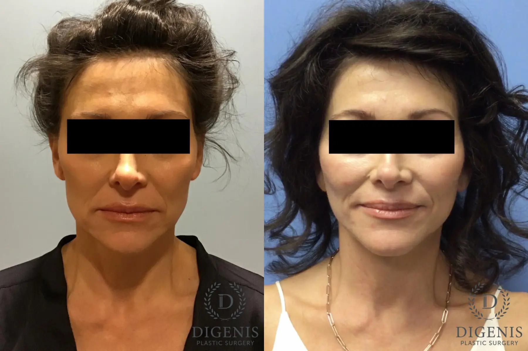 Facelift: Patient 10 - Before and After  