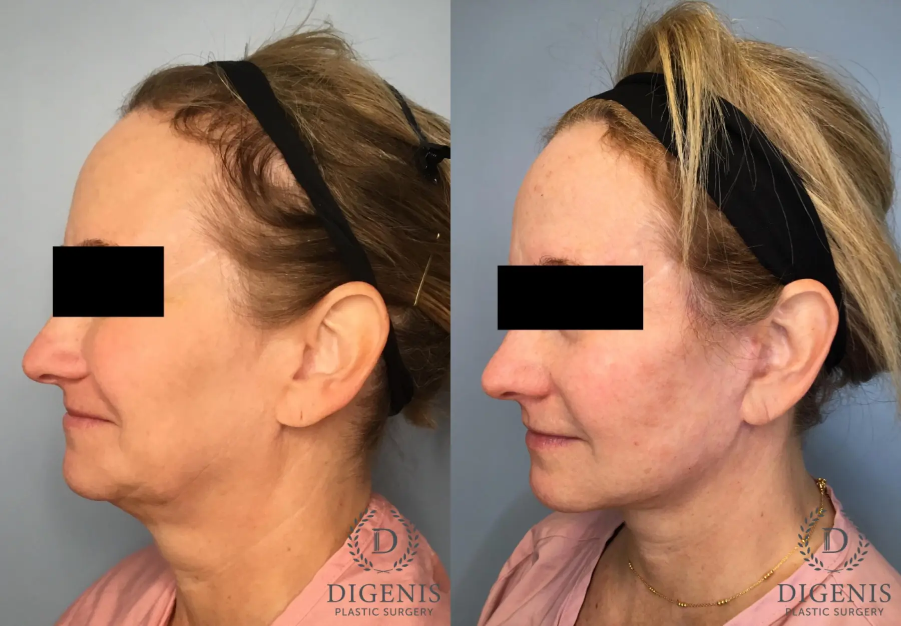 Facelift: Patient 13 - Before and After 4