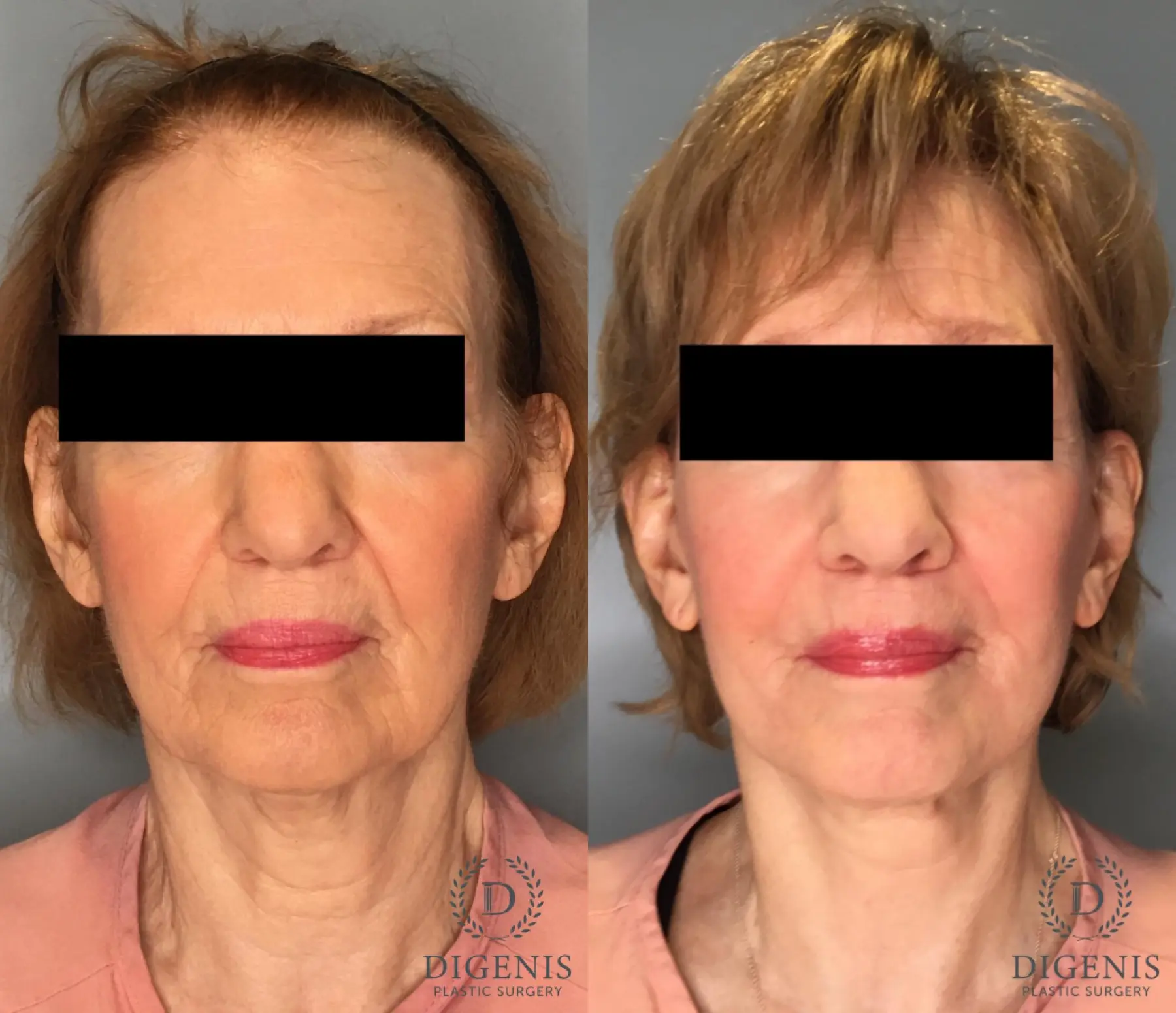 Facelift: Patient 21 - Before and After  
